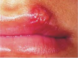 Herpes i munden